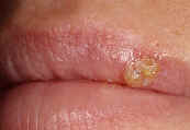 Cold Sore