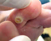 Corn on Toe