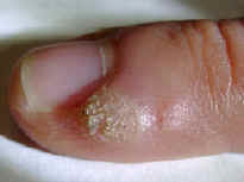 Wart